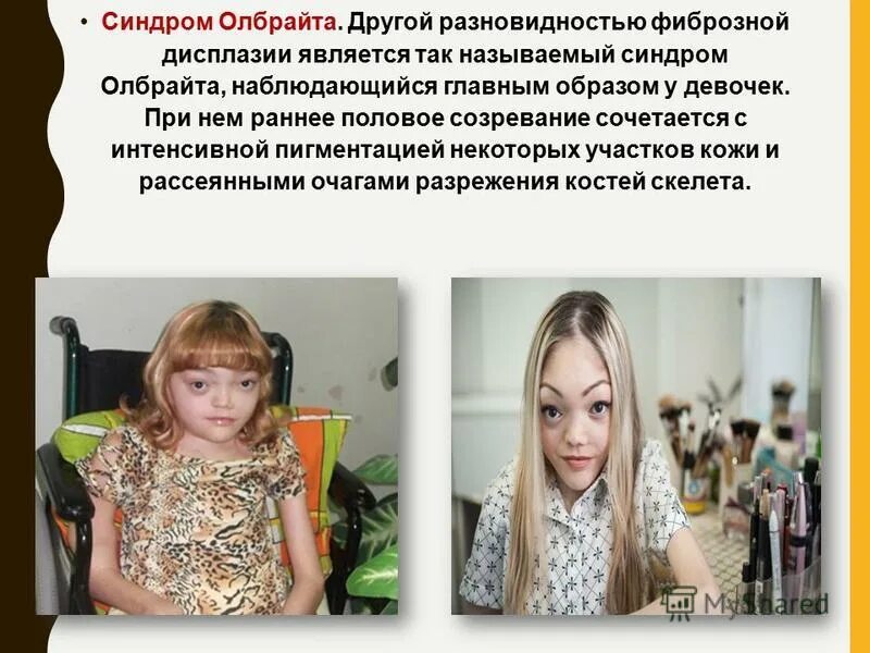 Синдром олбрайта. Синдром маккьюна олбрайта. синдром олбрайта болезнь лилия. болезнь мак кьюна олбрайта.
