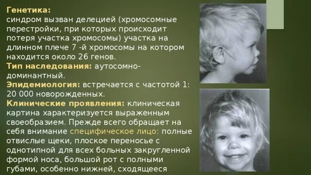 Генетика носа. Синдром Вильямса Бойрена. Генетические синдромы у детей.