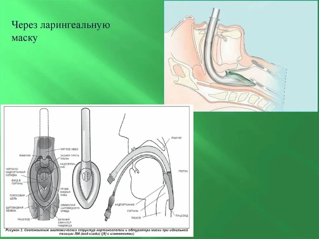 Размеры ларингеальных масок. Интубация ларингеальной маской. Постановка воздуховода и ларингеальной маски. Техника постановки ларингеальной маски. Маска ларингеальная 3.