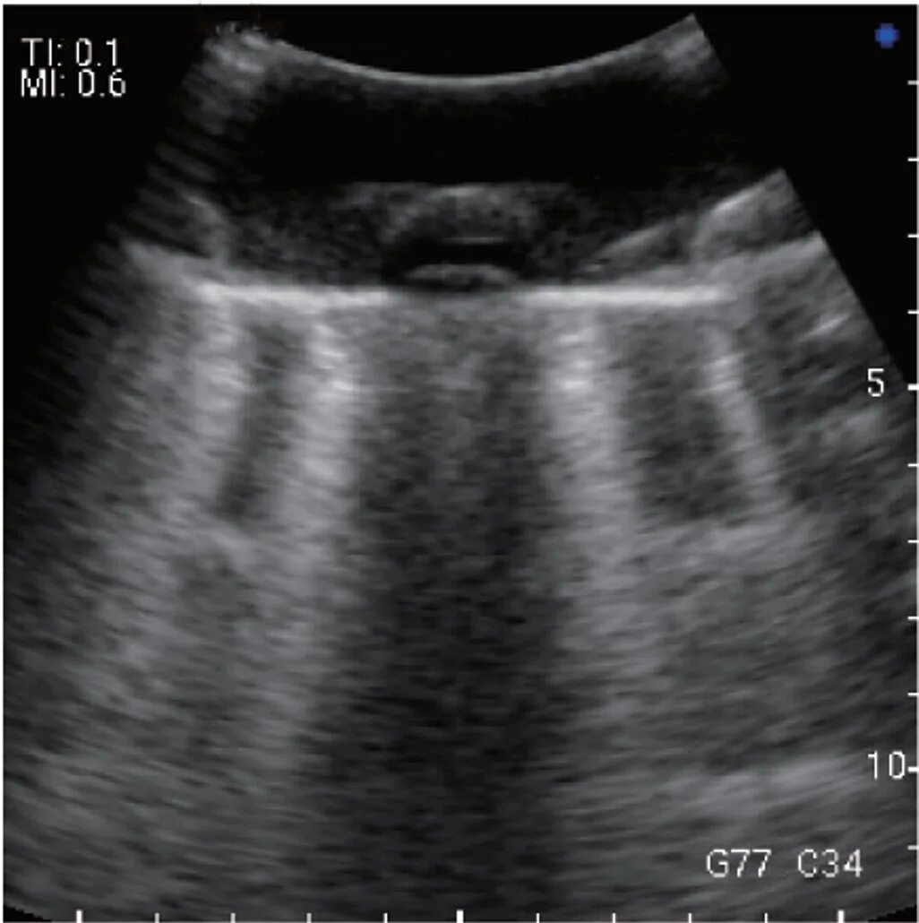 Обучение узи ultrasonicthyroid ru. Консолидация легких на УЗИ. В линии на УЗИ. А И Б линии на УЗИ. В-линии на УЗИ легких.