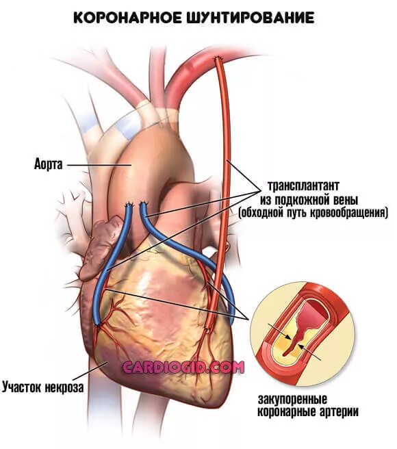 Шунт в медицине. Шунтирование коронарных артерий. Коронарное шунтирование сосудов. Схема операции аортокоронарного шунтирования. Операция шунтирование сосудов сердца.