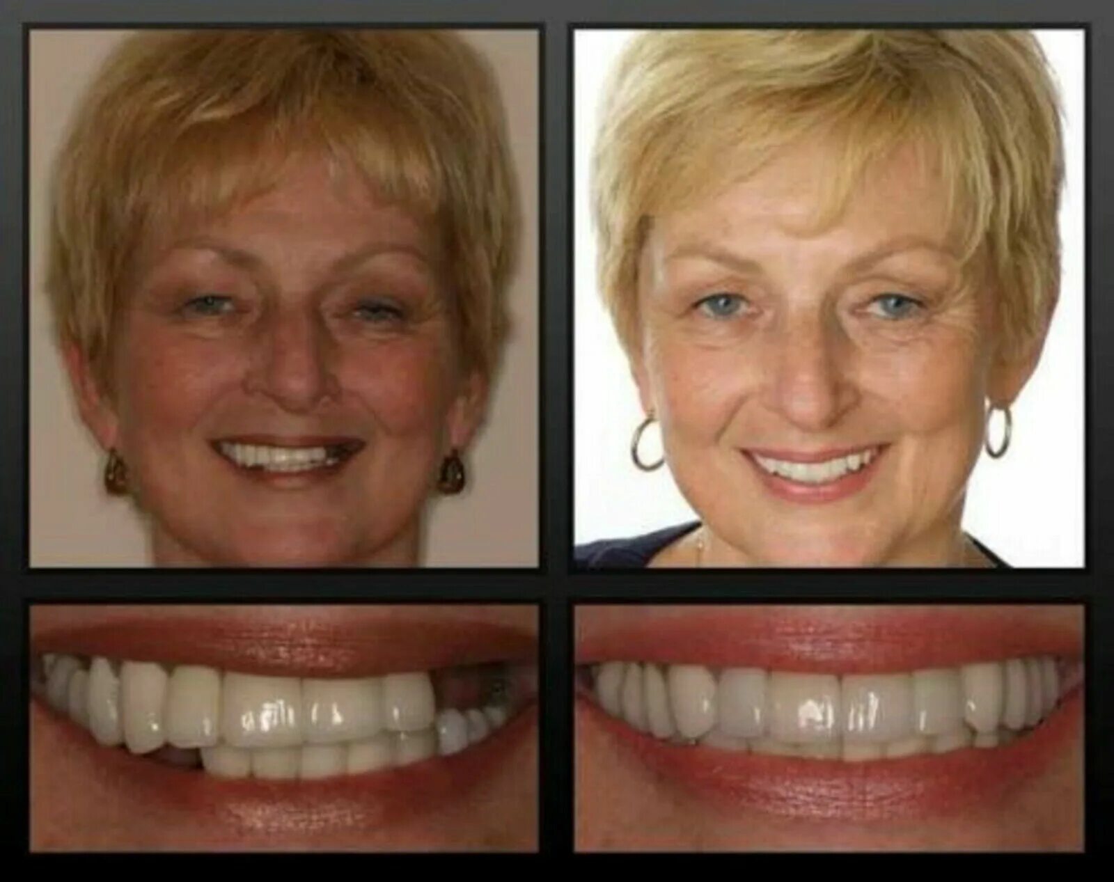 Сколько по времени делают зубы. Имплант зубов до после. Зубы до и после имплантации. Импланты зубы до и после. Съемные протезы передних зубов.