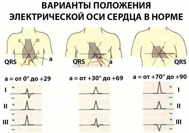 Кардиограммы положение эос. Отклонение электрической оси влево на экг. определить электрическую ось сердца по экг. положение электрической оси сердца отклонение. отклонение электрической оси сердца как определить.