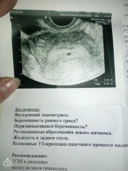 УЗИ беременности 5 недель эндометрий. УЗИ на 5 неделе беременности от зачатия. УЗИ внематочной беременности 3 недели. УЗИ 2 недели беременности. Через сколько видна беременность