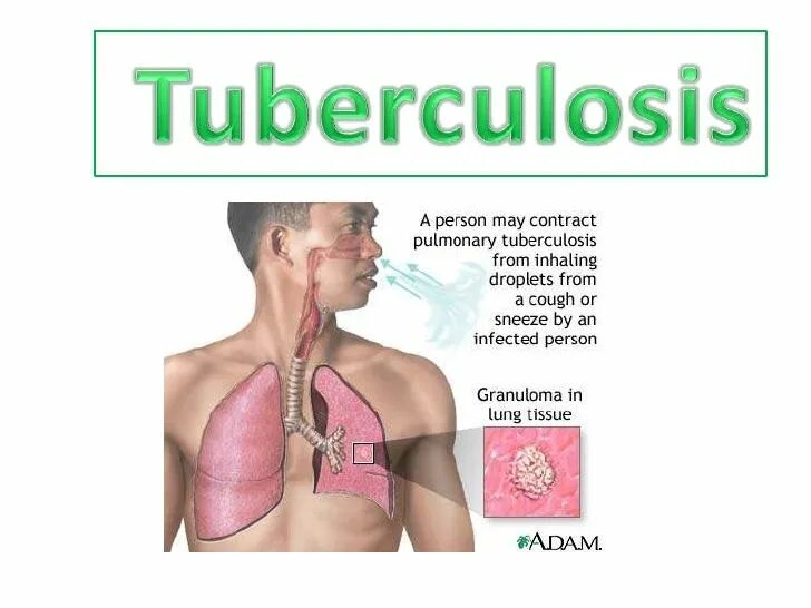 Tuberculosis disease. Микобактерии туберкулеза в легких. Tuberculosis disease. Микобактерия туберкулеза. Tuberculosis disease.