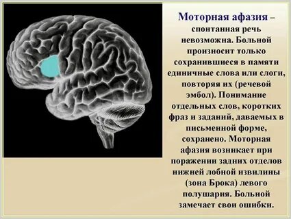 Моторная дисфазия