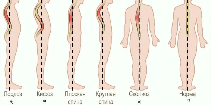 Нормальная поясница. Лордоз поясничный 2 степени. Сколиоз кифоз кифосколиоз. Сглажен лордоз в поясничном отделе позвоночника. Лордоз кифоз сколиоз.