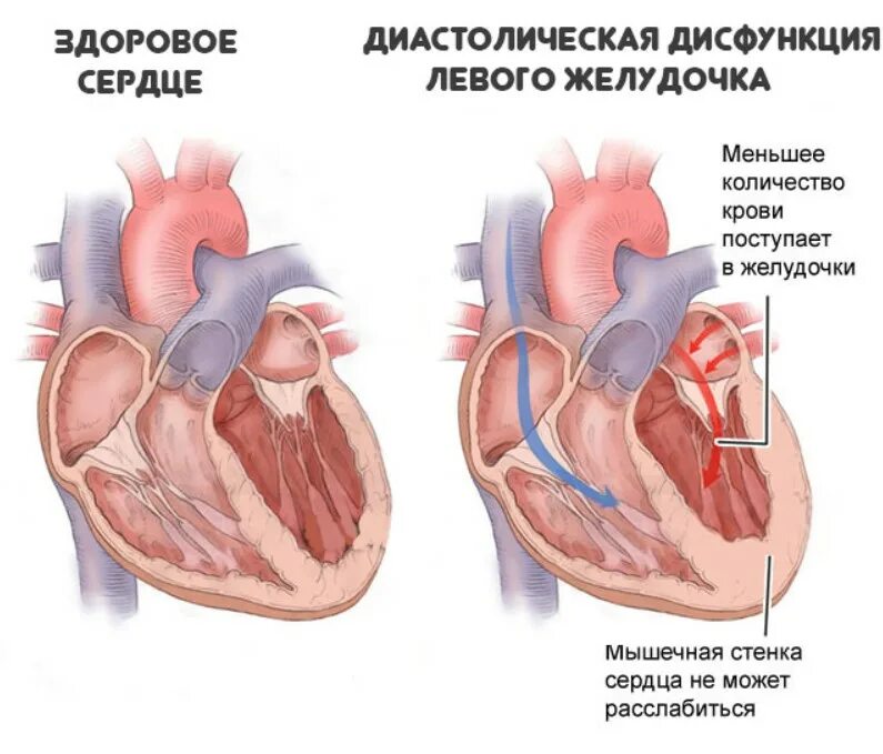 Нарушение функции левого желудочка. Диастолическая функция левого желудочка. диастолическая дисфункция левого желудочка по 1. диастолическая дисфункция левого желудочка е/а. диастолическая дисфункция левого желудочка на эхокг.
