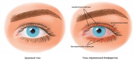 Первый признак ячменя