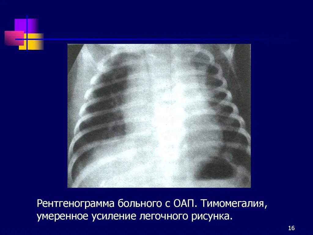 Тимомегалия. Тимомегалия на рентгене у ребенка. Усиление легочного рисунка у ребенка. Тимомегалия у детей 1 степени на рентгене.