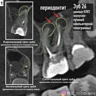 Периодонтит зуба что