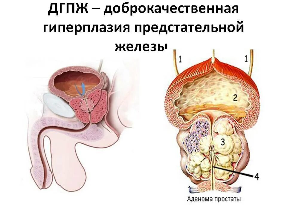 Методы лечения предстательной железы. Аденома предстательной железы и ДГПЖ. Узловая гиперплазия предстательной железы этиология. ДГПЖ предстательной железы что это такое.
