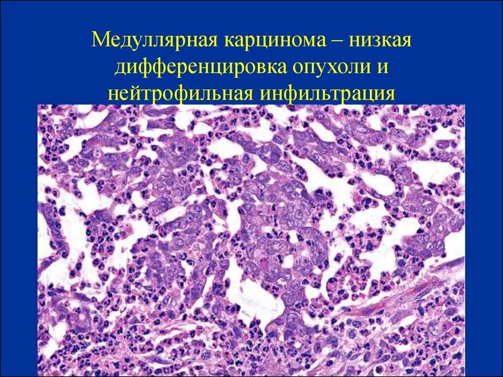 Медулярный рак. Карцинома щитовидной железы гистология. Медуллярная карцинома молочной железы гистология. Опухоли щитовидной железы патанатомия. Опухоли поджелудочной железы гистология.