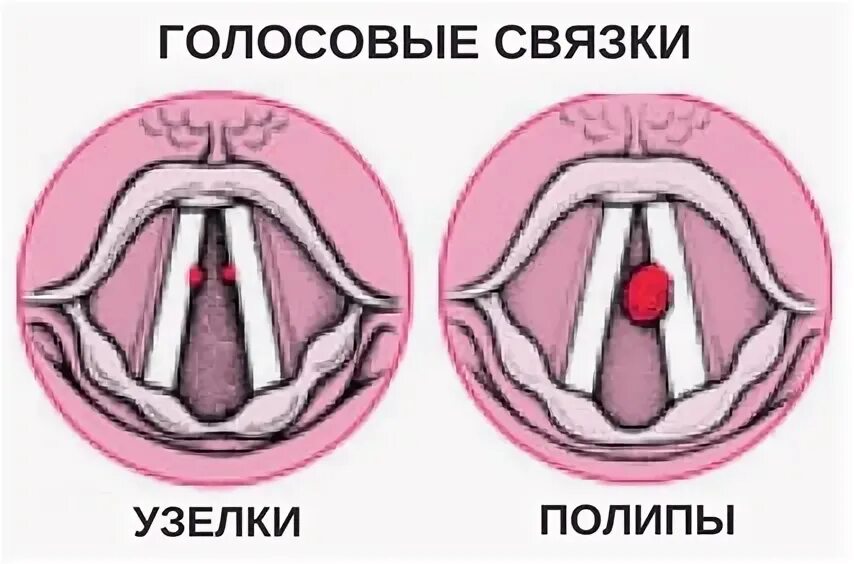 Пою на связках. Узелки голосовых складок ларингоскопия. Полипы голосовых связок. Полип голосовой складки.