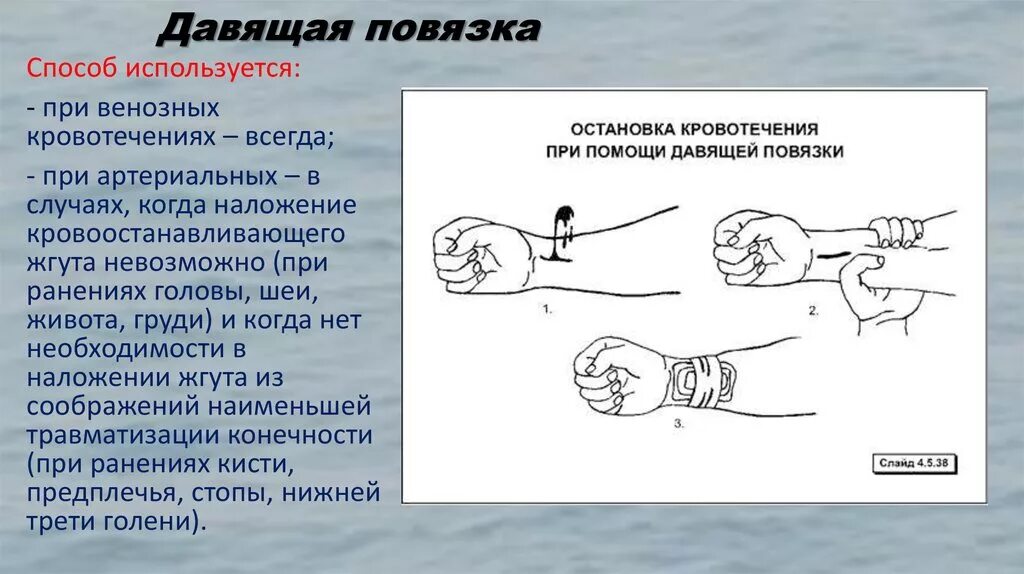 Остановка венозного кровотечения наложение повязки давящей. Давящей повязки при венозном кровотечении. Давящая повязка применяется для.