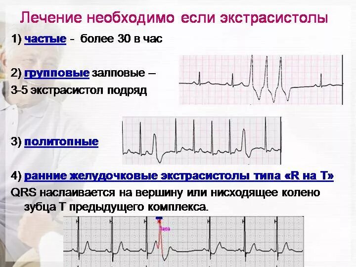 Можно вылечить экстрасистолию полностью