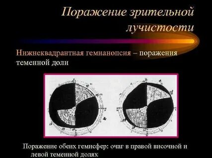 Поражение зрительных путей