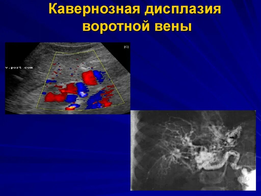 Сосудистая аномалия. Тромбоз портальной вены УЗИ. Кавернозная трансформация воротной вены на УЗИ. Тромбоз печеночной вены кт. УЗИ печени, воротная Вена , холедох.