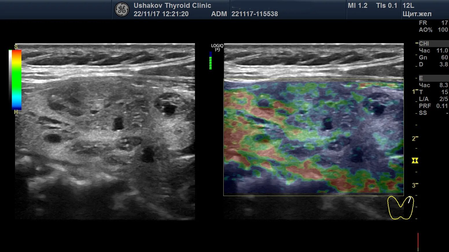 Ti- rads 3 на УЗИ щитовидной железы. Классификация Tirads щитовидная железа УЗИ. Ti rads 2 щитовидной железы. Узел левой доли щитовидной железы ti-rads 5. Перинодулярный кровоток что это
