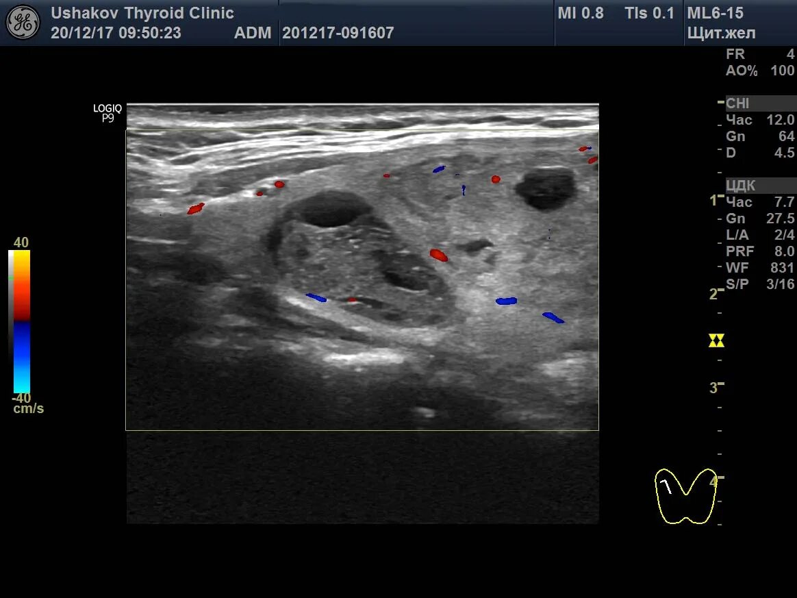 Узел в левой доле щитовидной железы. Щитовидная железа УЗИ ti-rads. Узел левой доли щитовидной железы ti-rads. Ti-rads 1 щитовидной железы. Узел правой доли щитовидной железы ti-rads 5.