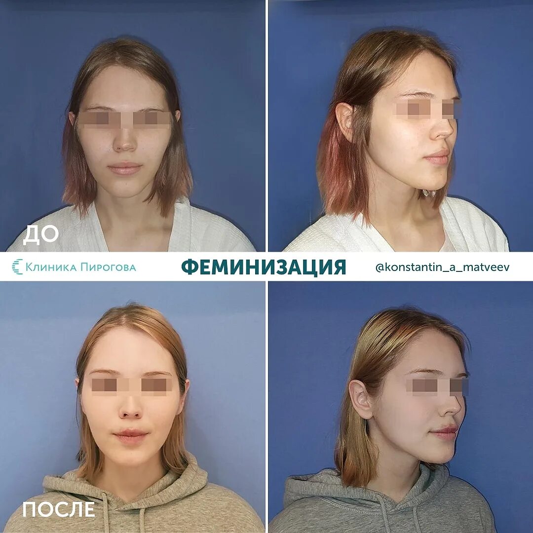 Фото до и после пластических операций. Ринопластика. Матвеев К.А. от 08 Января 2