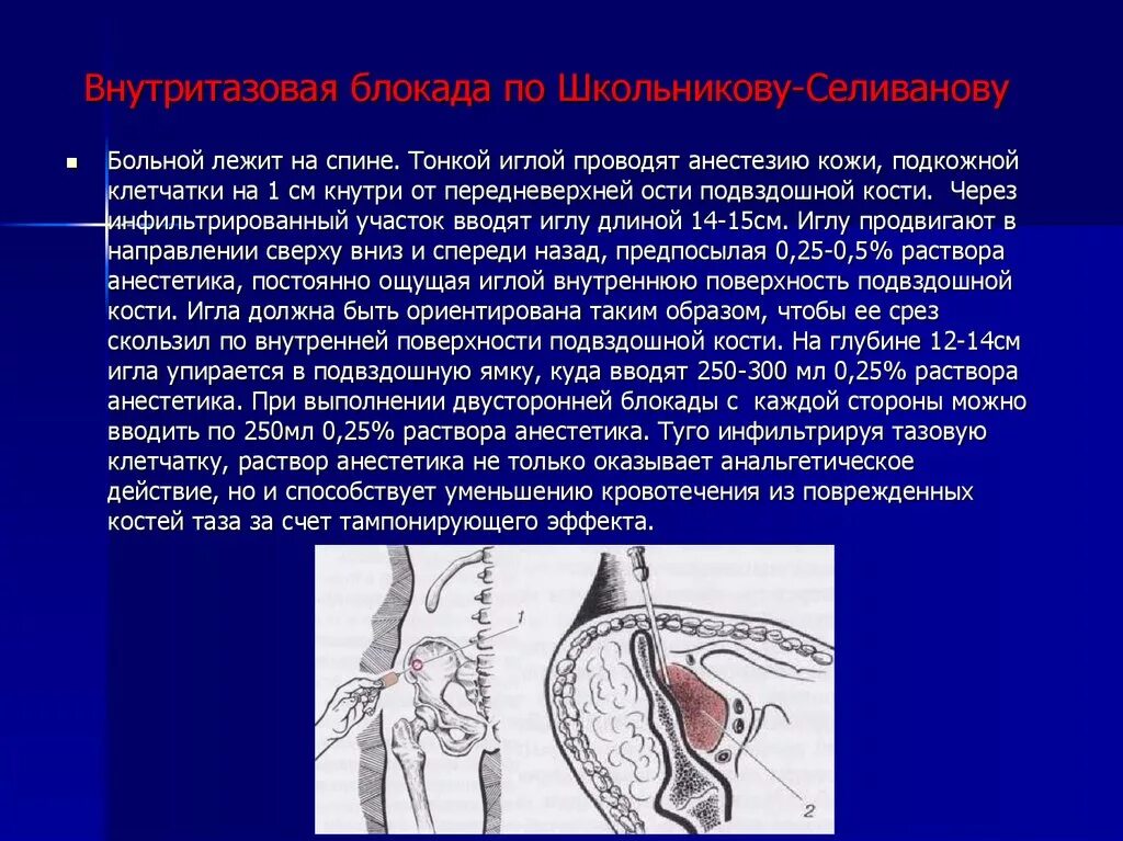 Блокады половые. Внутритазовая новокаиновая блокада по Школьникову. Блокада по Школьникову-Селиванову Цодыксу. Тазовая блокада по Школьникову Селиванову. Новокаиновая блокада Школьникова Селиванова.