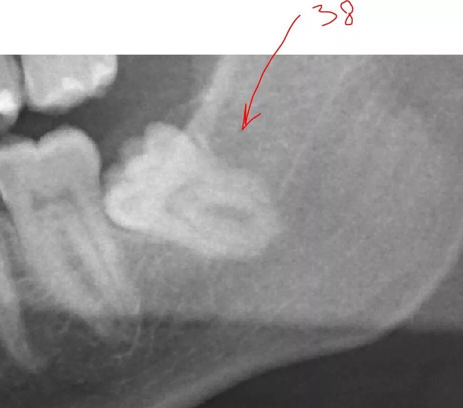 Зуб 8 корень. Снимок зуба мудрости снизу. Рентген зубов мудрости сбоку. Зуб мудрости растет сбоку. Зуб мудрости справа снизу.