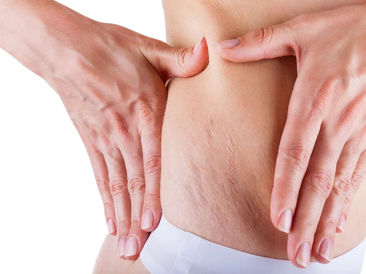 Растяжки stretch marks. Растяжки stretch marks