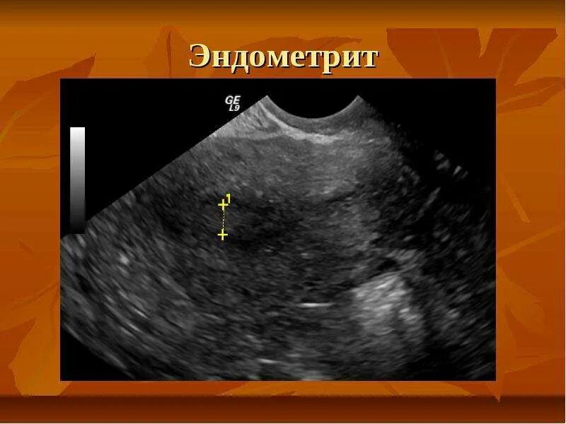 Какая матка при воспалении. Хронический эндометрит УЗИ. УЗИ матки с хроническим эндометритом. Послеродовой эндометрит матка.