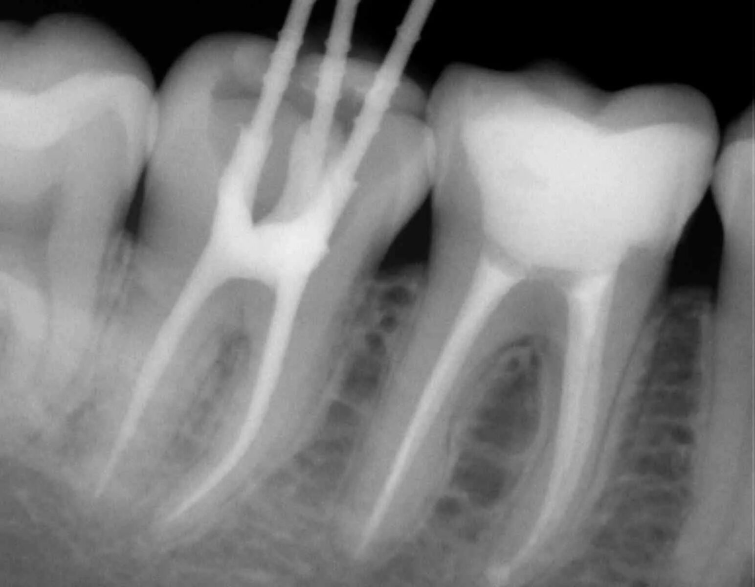Расширение каналов зубов. Периапикальный периодонтит. Пломбировка каналов зуба рентген. Запломбированные корневые каналы зуба.