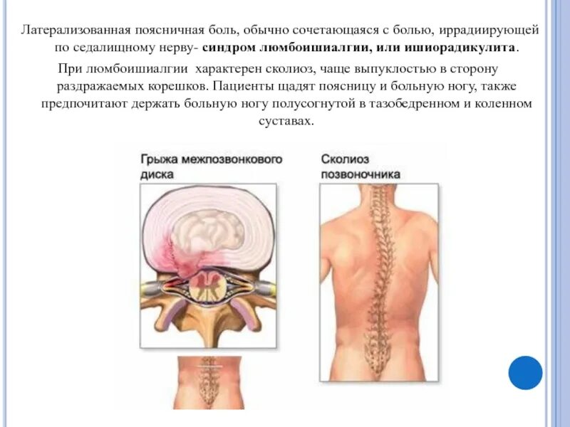 Люмбоишиалгия карта вызова. Поясничный синдром люмбоишиалгия. Люмбоишиалгия поясничного отдела позвоночника. Люмбоишиалгия пояснично-крестцового отдела. Паравертебральные точки поясничного отдела.