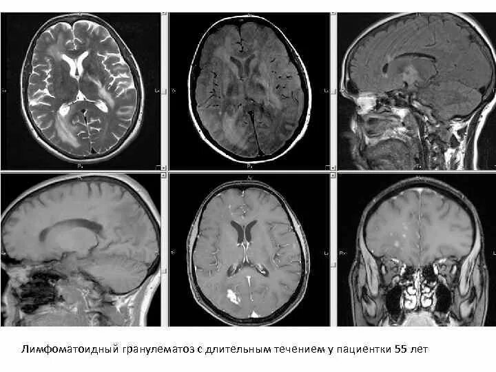 Гранулематоз Вегенера мрт головного мозга. Лимфоматоидный гранулематоз. Демиелинизация головного мозга мрт. Демиелинизация водопровод мрт. Демиелинизация головного