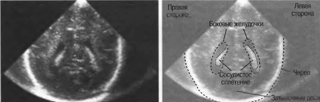 Сосудистые сплетения головного мозга у плода на УЗИ. Киста сосудистого сплетения УЗИ. Киста сосудистого сплетения у плода. УЗИ плода кисты сосудистых сплетений. Сосудистая киста головного мозга у плода