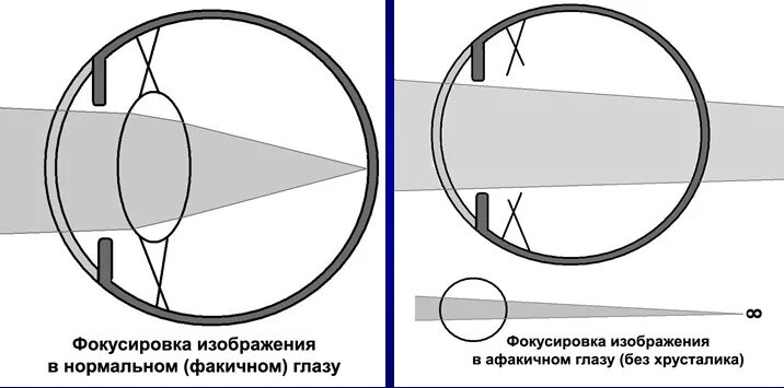 Фокусировка глаза. Близорукость и дальнозоркость изображение на сетчатке. Фокусировка зрения у нормальных людей. Фокусировка зрения у нормальных людей. Нормальное зрение.