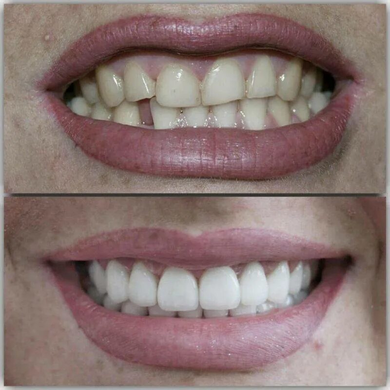 Композитные виниры щербина. Композитные виниры эстелайт. Реконструкция передних зубов. Восстановление передних зубов. Керамокомпозитные виниры.