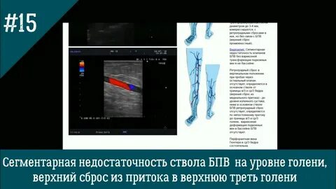 Узи глубоких вен нижних конечностей