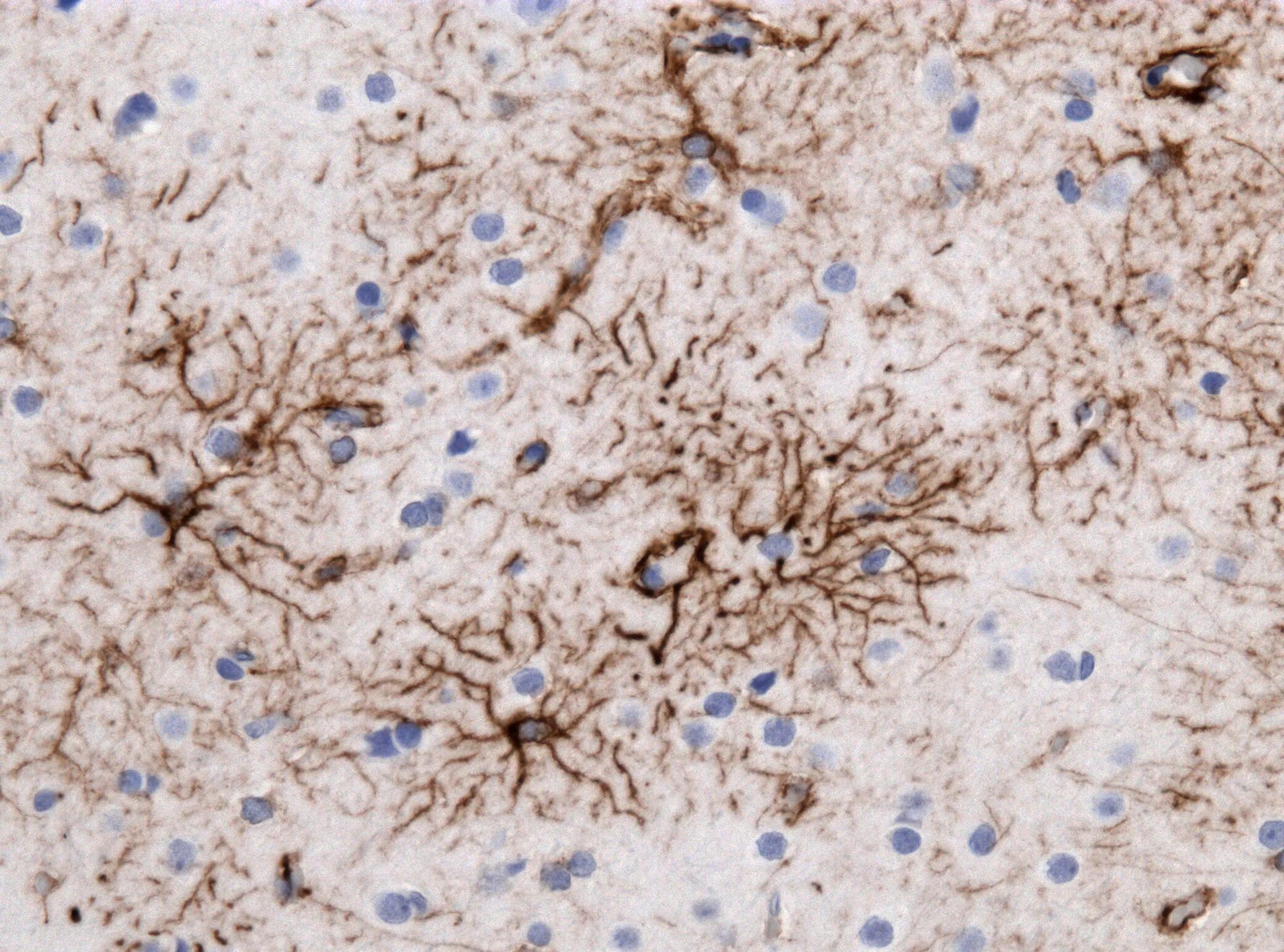 Анализ на лямблии. Анализы при лямблиозе у взрослых. Lamblia intestinalis переносчик. Игх на лямблии. Игх на лямблии.