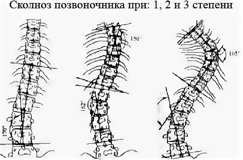 Сколиоз 2 степени это. Сколиоз с ротацией позвонков. Сколиоз 2 степени с ротацией позвонков. Ротация позвонков при сколиозе 1 степени. Ротация позвонков при сколиозе рентген.