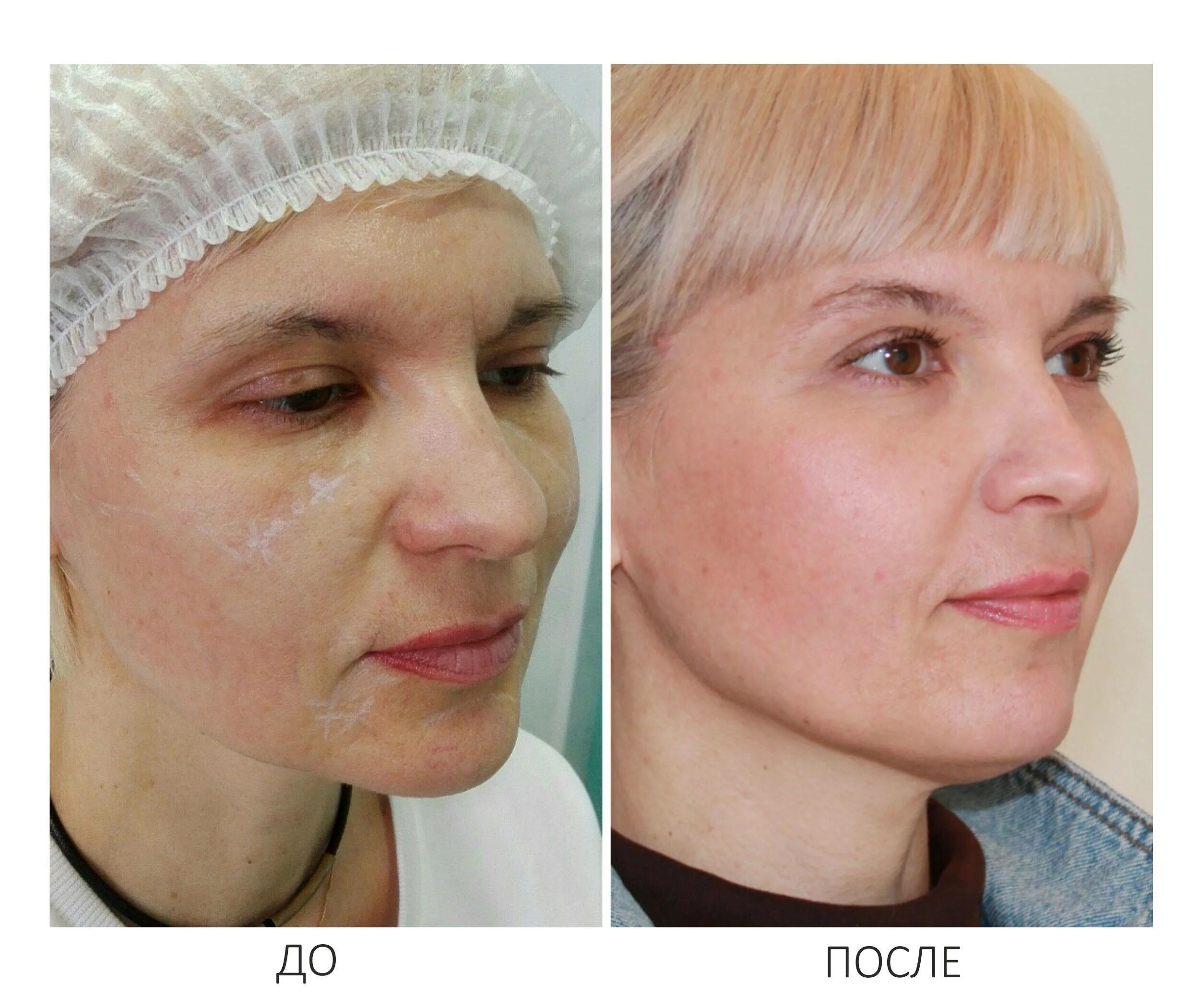 Контурная пластика лица skinlift. Пластика лица. Контурная пластика лица. Пластика контура лица. Коррекция овала лица до и после.