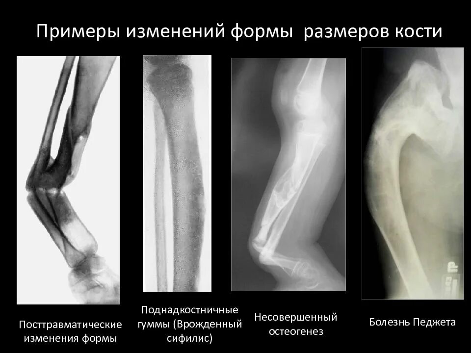 Изменение формы костей. Лучевая семиотика заболеваний костно-суставной системы. Изменений формы кости рентген. Изменение длины кости рентген. Изменение формы кости