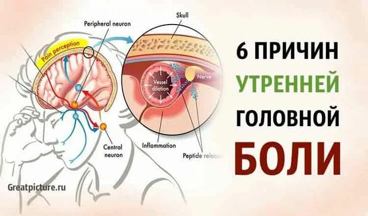 Утром сильно болит голова. Причины головной боли. Утренняя головная боль причины. Почему болит голова. Причины почему болит голова.