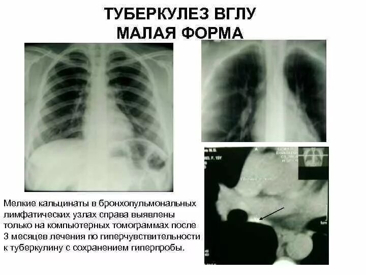 Формы туберкулеза внутригрудных лимфатических узлов. Малая форма туберкулеза внутригрудных лимфатических узлов рентген. Туберкулез внутригрудных лимфатических узлов рентгенограмма. Туберкулез внутригрудных лимфоузлов малая форма. Кальцинаты в лимфоузлах