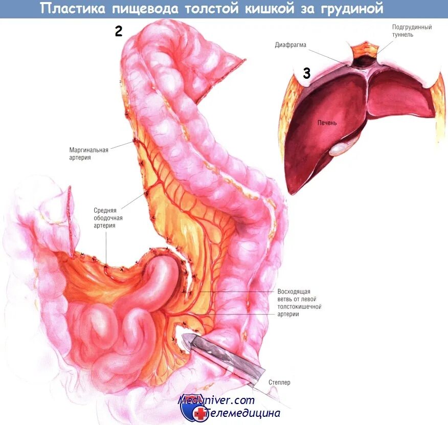 Пищевод печень толстая. Эзофагопластика толстой кишкой. Эзофагопластика пищевода желудком. Пластика пищевода толстой кишкой техника операции. Тонкокишечная пластика пищевода.