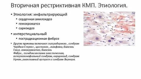 Вторичный амилоидоз заболевания