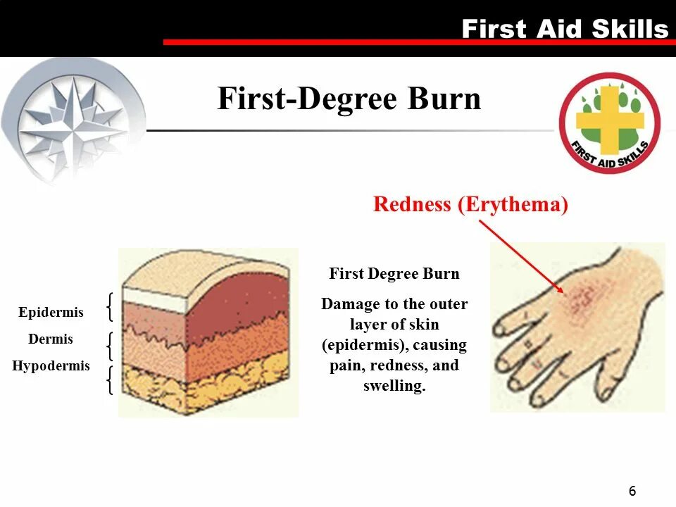 First burn. First burn. Первая помощь на английском языке. First burn. First burn.