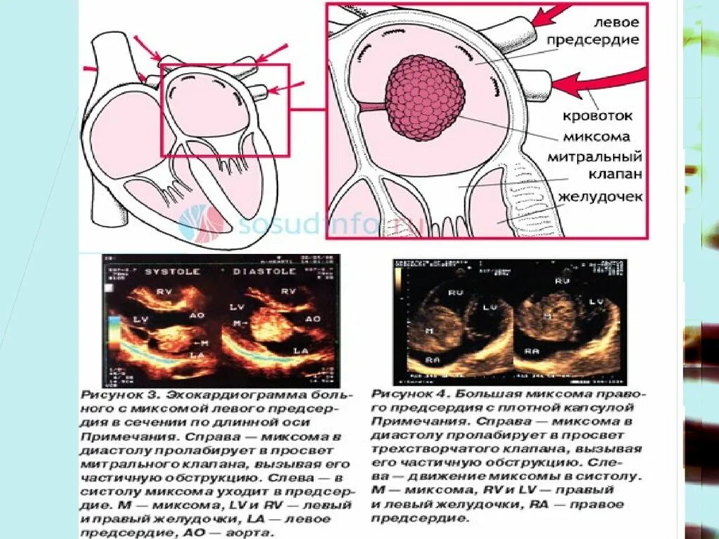 Образование левого предсердия. Миксома левого предсердия. Опухоль сердца миксома. Миксома левого предсердия на ЭХОКГ. Миксома правого предсердия.