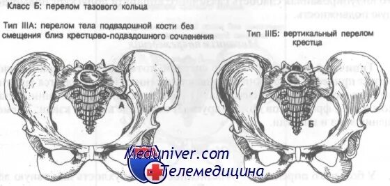 Перелом гребня. Осложнения перелома лонной кости. перелом крыла и тела подвздошной кости. перелом тела подвздошной кости. перелом лонной и тазовой кости без смещения.