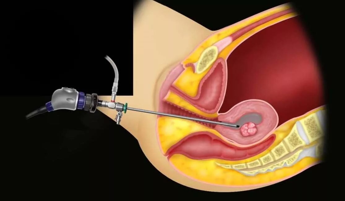 Гистероскопия полипэктомия. . Гистероскопия (субмукозные узлы).. Выскабливание полипа эндометрия. Гистерорезектоскопия полипа матки.