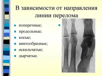 Перелом при котором линия перелома начинается