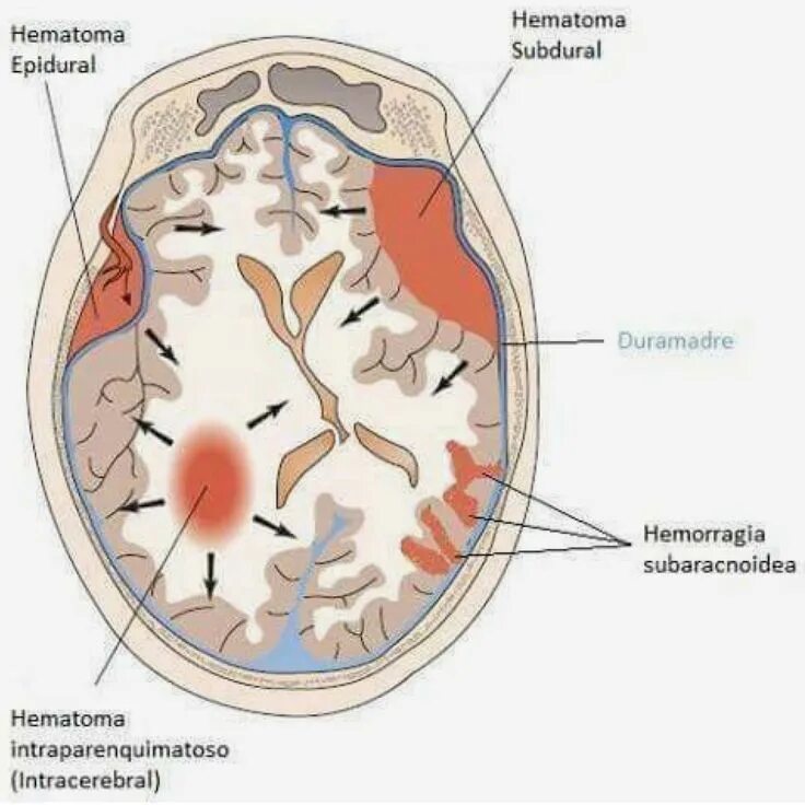 Эпидуральная субдуральная. Внутричерепные гематомы классификация. Эпидуральная субдуральная и внутримозговая гематома. Гематомы головного мозга классификация. В кости есть мозг